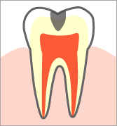 【Ｃ2】 むし歯の第二段階 