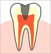 【Ｃ3】 むし歯の第三段階