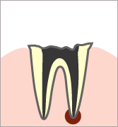【Ｃ4】 むし歯の第四段階
