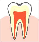 【Ｃ１】 むし歯の第一段階 