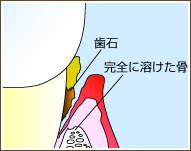 【P4】 重度歯周炎