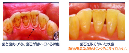 歯石除去について