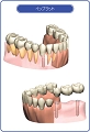 インプラント治療