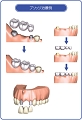 ブリッジ による治療