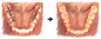 セラミックインレー